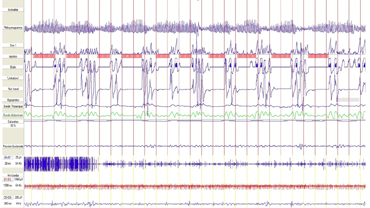 Polysomnography display showing EEG and other physiological channels recorded during sleep